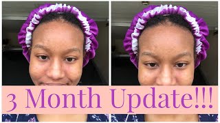 3 Month Metronidazole Cream for Perioral Dermatitis Update  Before and After Photos Included [upl. by Wilterdink]