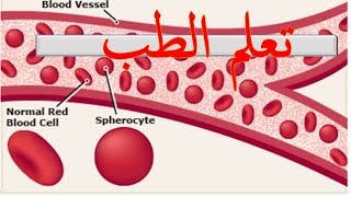 Hereditary spherocytosis [upl. by Ahab308]