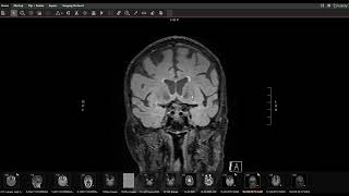 Is it MS or signs of high blood pressure and cholesterolMRI findings [upl. by Eli]