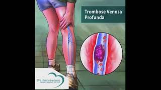 Trombose Venosa Profunda [upl. by Brigida]