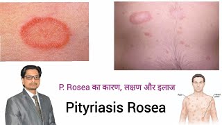 Pityriasis Rosea  P Rosea का कारण लक्षण और इलाज pityriasis rosea treatment in hindi prosea [upl. by Fatsug547]