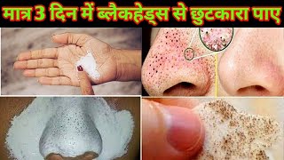 ब्लैकहेड्स हटाने के घरेलू उपायblackhead removal [upl. by Theobald]