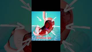 Stomach Endoscopy animation trendingshortstrendingshortsshortfeed [upl. by Sirod507]