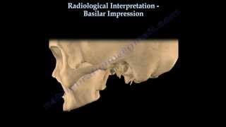 Basilar Impression Radiological Interpretation  Everything You Need To Know  Dr Nabil Ebraheim [upl. by Licko868]