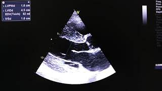 Hypertensive heart disease HHD [upl. by Liahkim770]