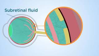 Subretinal fluid a novel approach to macular holes [upl. by Yedok]