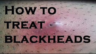 How to treat blackheads [upl. by Rape]