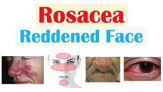 Rosacea Red Lesions on Face  Causes Triggers Types Signs amp Symptoms Diagnosis Treatment [upl. by Jedidiah]