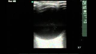 Ocular Ultrasound Vitreous Hemorrhage [upl. by Hewie]