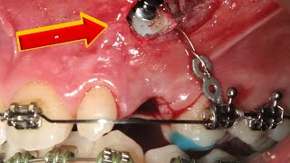 HOW BRACES WORK Awful Bucally IMPACTED CANINE before and after timelapse [upl. by Bessy]