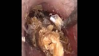 ear wax removal Satisfying Video Reaction usa earwaxremoval trendingvideo earrings satisfying [upl. by Deane257]