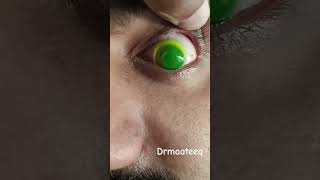 scleral contact lenses atseyecare drmaateeq eyecare eyes contactlenses [upl. by Ainatit]