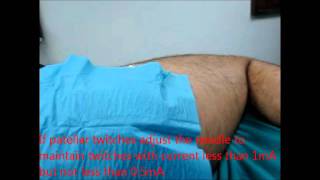 posterior lumbar plexus block nerve stimulationwmv [upl. by Ciardap]