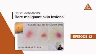 Fit for Dermoscopy Episode 12  Rare malignant skin lesions [upl. by Tacy]