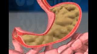 gastric reflux animation [upl. by Hoeve]