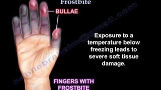 Frostbite UPDATE  Everything You Need To Know  Dr Nabil Ebraheim [upl. by Denyse643]