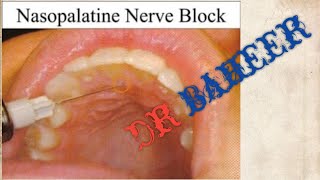 nasopalatine nerve block [upl. by Joselyn]