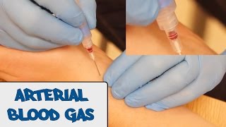 Arterial Blood Gas Sampling ABG  OSCE Guide old version  UKMLA  CPSA [upl. by Allerym]