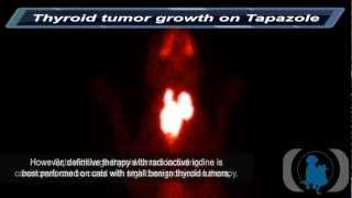 Thyroid Tumor Growth on Tapazole [upl. by Aneloaup]