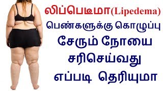 லிப்பெடீமாLipedema பெண்களுக்கு கொழுப்பு சேரும் நோயை சரிசெய்வது எப்படி தெரியுமா [upl. by Larry759]