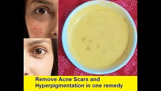 Remove Acne Scars amp pigmentation permanently [upl. by Ahsinyt]