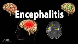 Encephalitis Animation [upl. by Lichtenfeld]