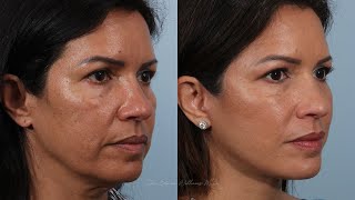 Day by Day Deep Plane Facelift Surgery Recovery [upl. by Krause]