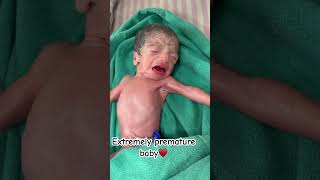 Extremely low birth weight baby born with 950garm ankur maitrika hospital 🏥♥️ [upl. by Eelahc]