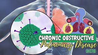 New Advances in Treatment and Understanding of Chronic Obstructive Pulmonary Disease [upl. by Keyser797]