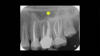 für Zahnärzte ein Röntgen kann täuschen [upl. by Aihtyc]