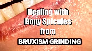 Bony spicule removal with commentary [upl. by Sug62]