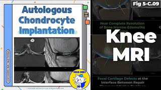 Fig 5C09 MRI Findings of Autologous Chondrocyte Implantation [upl. by Zwick]