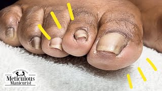 How to Fix Toenail Discomfort [upl. by Atauqal]