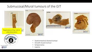 Colon Large intestine Leiomyoma Gross pathology [upl. by Artened251]