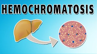 Hemochromatosis [upl. by Riannon393]