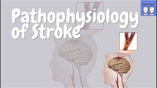 Stroke Pathophysiology Ischaemic VS Haemorrhagic TIAs Signs and Symptoms Treatments [upl. by Moise]