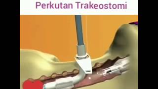 Como é feito a traqueostomia [upl. by Oruam]