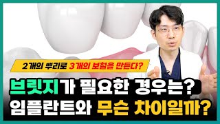 치아 브릿지 과정과 필요한 경우 임플란프와 차이점  치과 의사 문현국 [upl. by Ronnie]