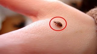 How to Treat Bed Bug Bites Naturally [upl. by Anhaj735]