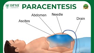 Paracentesis Peritoneal Fluid Analysis Or Ascitic Fluid Analysis Ascites  Causes amp Symptoms [upl. by Biddie]