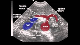 Abdominal Aortic Aneurysm AAA Ultrasound [upl. by Osnohpla477]