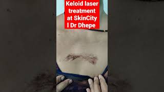 keloid laser treatment at SkinCity l Dr Dhepe [upl. by Gaye]