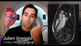 Cardiac MRI Planning  Full Guide Part 1 [upl. by Naji]