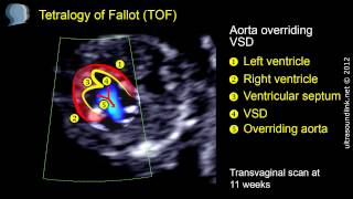 Tetralogy of Fallot TOF echo at 11 weeks [upl. by Stacee255]