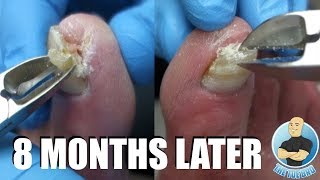 PATIENT OF MY MOST VIEWED VIDEO RETURNS INGROWN TOENAIL TREATMENT [upl. by Torrin]