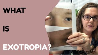 What Is Exotropia And How Do We Treat It [upl. by Anivel190]