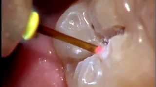 Tratamiento de caries sin dolor y sin anestesia Láser dental [upl. by Erkan]