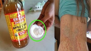 tinea versicolor treatment  how to get rid of tinea versicolor natural treatment [upl. by Doerrer]