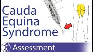 Cauda Equina Syndrome  Signs amp Symptoms [upl. by Enair]