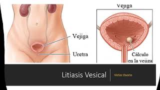 Litiasis Vesical [upl. by Reiss]